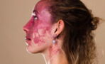 They made fun of her birthmark, but she's turned it into something inspiring