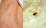 Paris Bed Bug infestation: How to tell the difference between theirs and mosquito bites?