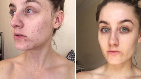 This Woman Stopped Washing Her Face For Six Months And Cured Her Acne