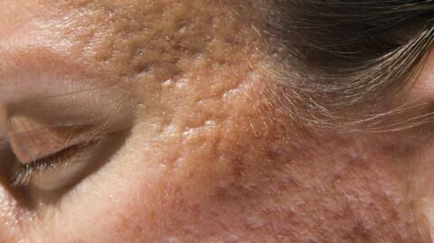 Atrophic scarring: What it is and how to treat it