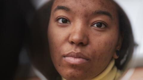 How to eliminate post-inflammatory hyperpigmentation