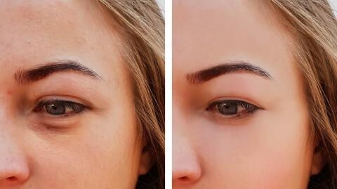 Dark circles: The newest trend taking over the makeup community