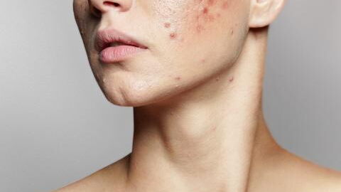 Acne: Could this superfood be the cure?