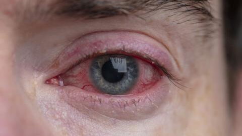 Red eye: Here's when to see a doctor