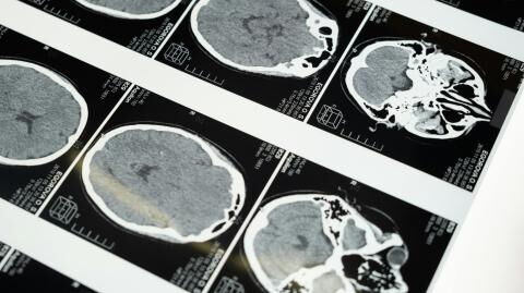 This man did not realise he had chopstick stuck in his brain for 5 months