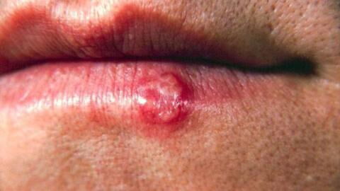 Home remedies to get rid of cold sores