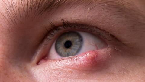 Say goodbye to your stye with these natural remedies