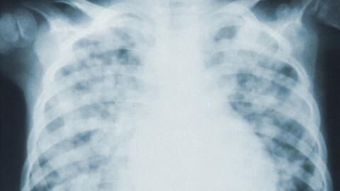 COVID pneumonia: Most common symptoms to watch out for