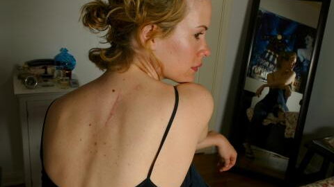 Breast cancer: Having moles on your skin can increase risk of cancer, studies show