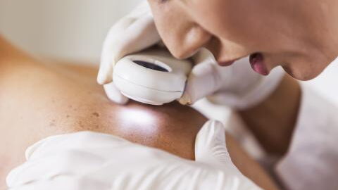 The type of mole on your body could be an early sign of skin cancer