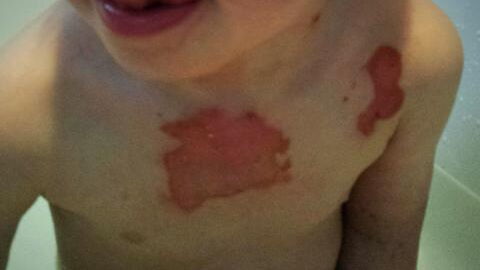 Tomato flu: Most common symptoms of the new virus circulating in India