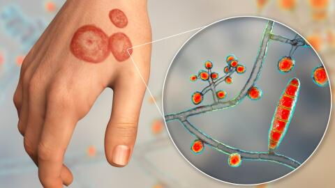 Tinea: First cases of highly contagious fungal infection reported, should we be worried?