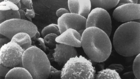 'Microscopic blood clots’ have been discovered in long COVID patients