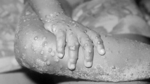 Monkeypox: The signs and symptoms of the virus detected in the UK