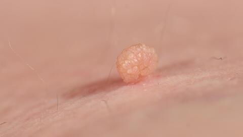 Home remedy for skin tags: Here's how to get rid of it easily
