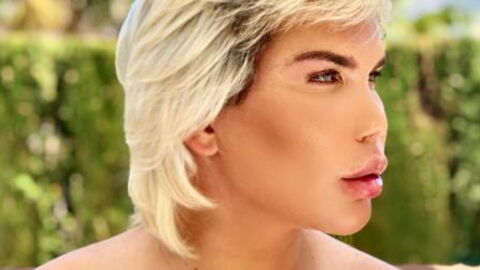 11 plastic surgeries later, the "Human Ken Doll's" nose has totally collapsed