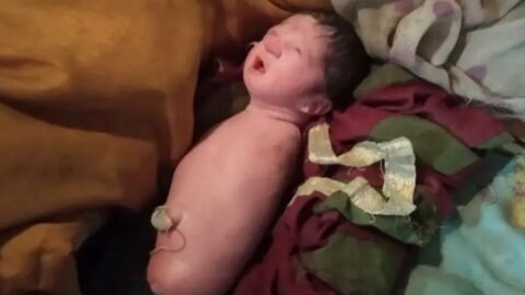 Doctors were left baffled as a baby Born in India was missing all four limbs