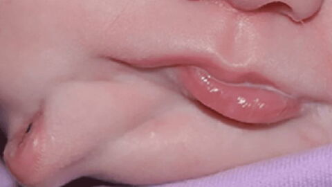 Diprosopus: this baby was born with a birth defect that has only been observed 35 times worldwide