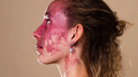 They made fun of her birthmark, but she's turned it into something inspiring