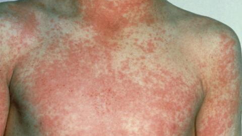 Cases of Victorian-era disease ‘unusually high’ in the UK. Know the symptoms