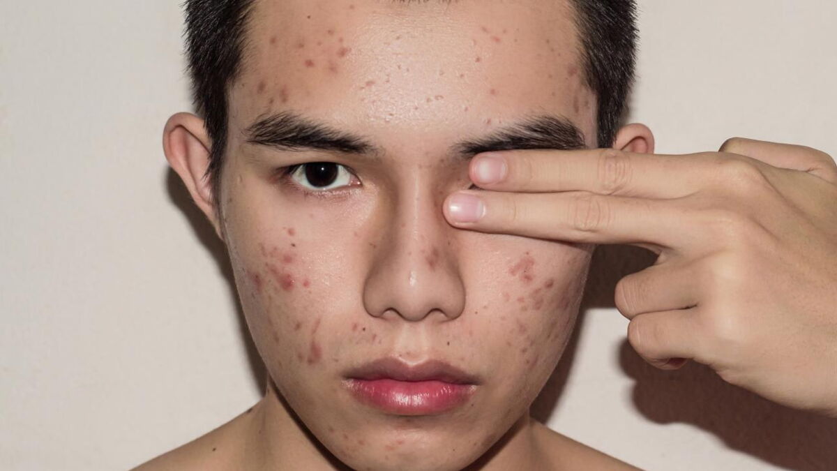 What causes acne?