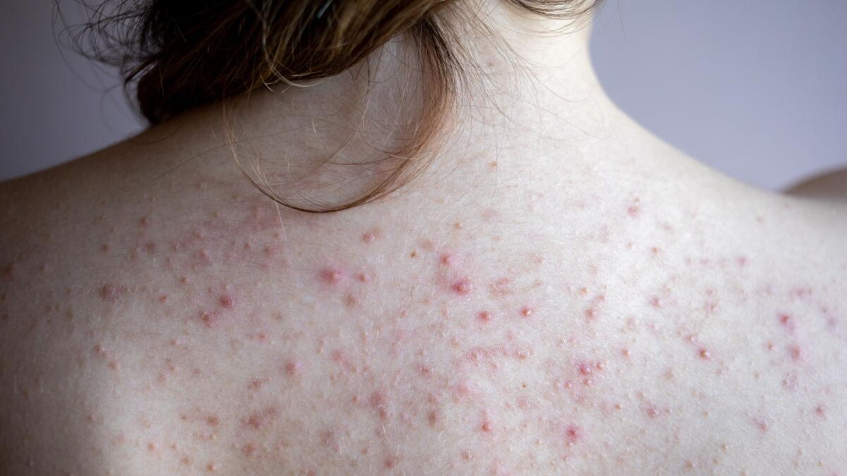 Everything you need to know about back acne