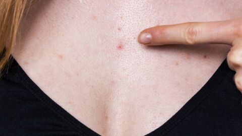 Chest acne: Why we get it and how to get rid of it