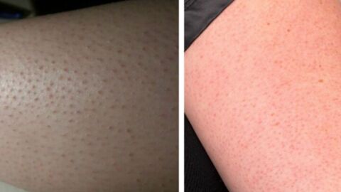 Keratosis pilaris: This is what causes those little red dots on your skin