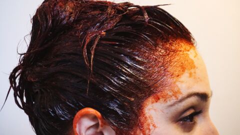 Woman's head swollen in 'worst allergic reaction' to hair dye