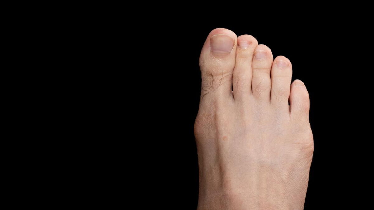 Signs of high cholesterol can be seen in your toenails