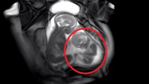Ces jumeaux essayent d'avoir un peu de place dans le ventre de leur mère. L'échographie est magnifique !