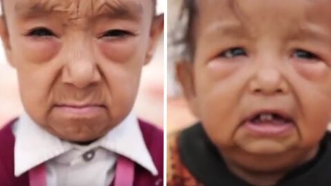 Progéria : la vie touchante de deux enfants atteints du ''syndrome de Benjamin Button''