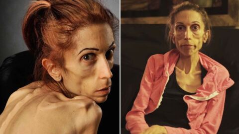 6 mois après son appel à l'aide, ce mannequin anorexique est méconnaissable