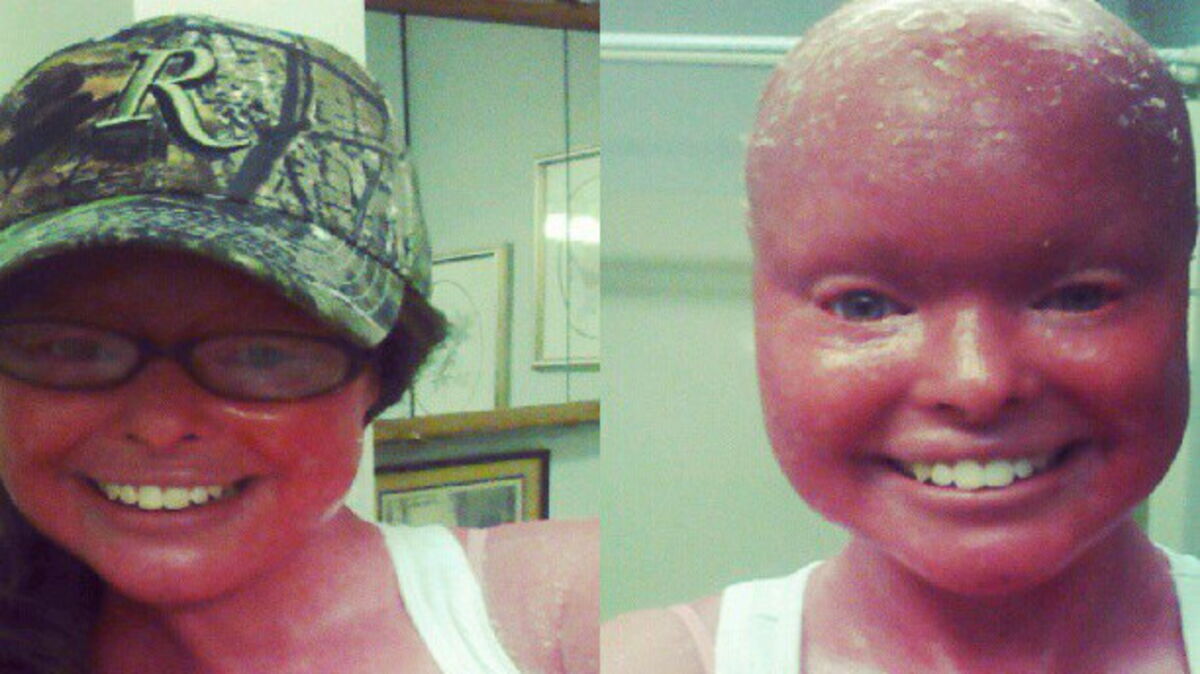 Atteinte Du Syndrome D Arlequin Son Histoire Va Vous Bouleverser