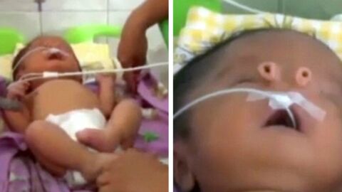 Au Pérou, un bébé naît avec deux trompes au lieu d'un nez
