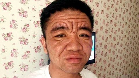 Atteint d'une maladie rare et âgé de 30 ans, cet homme a le visage d'une personne de 80 ans