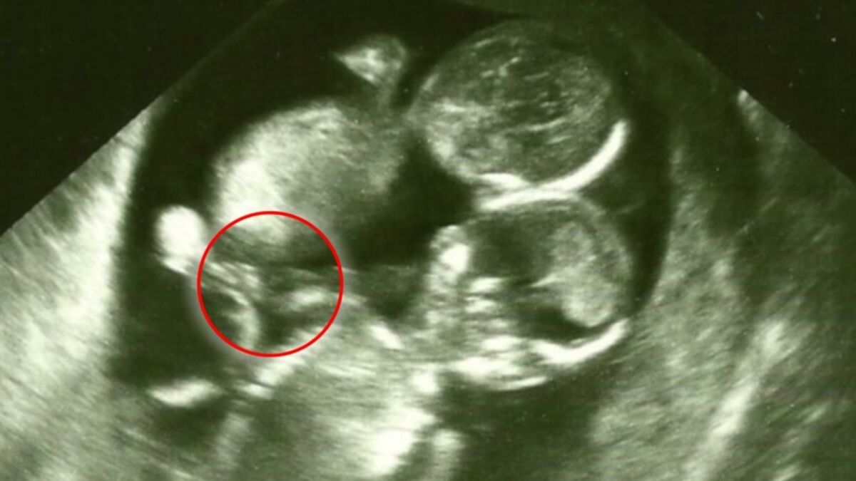 Двойня фото 15 недель беременности фото