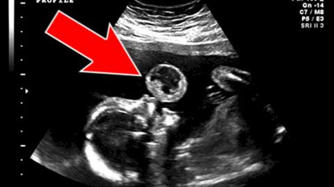 L'échographie de ce bébé 'faisant une bulle' cache une terrible réalité
