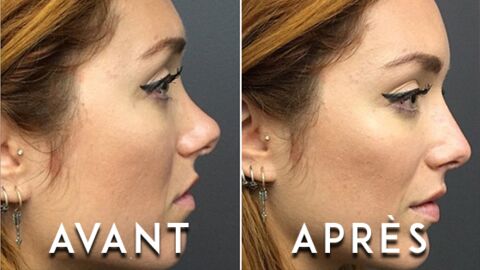 Un médecin transforme le nez d'une femme en 5 minutes... et sans chirurgie 