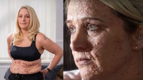 Bodypositive : Elle expose fièrement sa maladie de peau