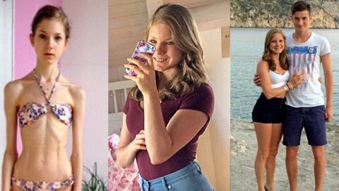 La transformation hallucinante d'une anorexique de 22 kilos