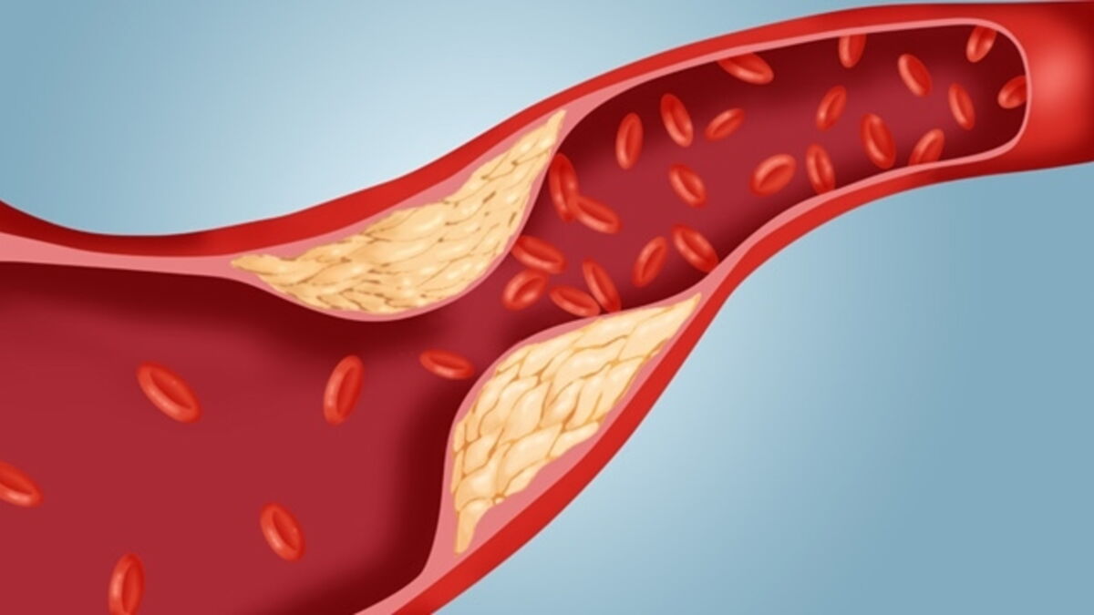 Cholestérol (HDL, LDL) le bon, le mauvais, de quoi s'agitil