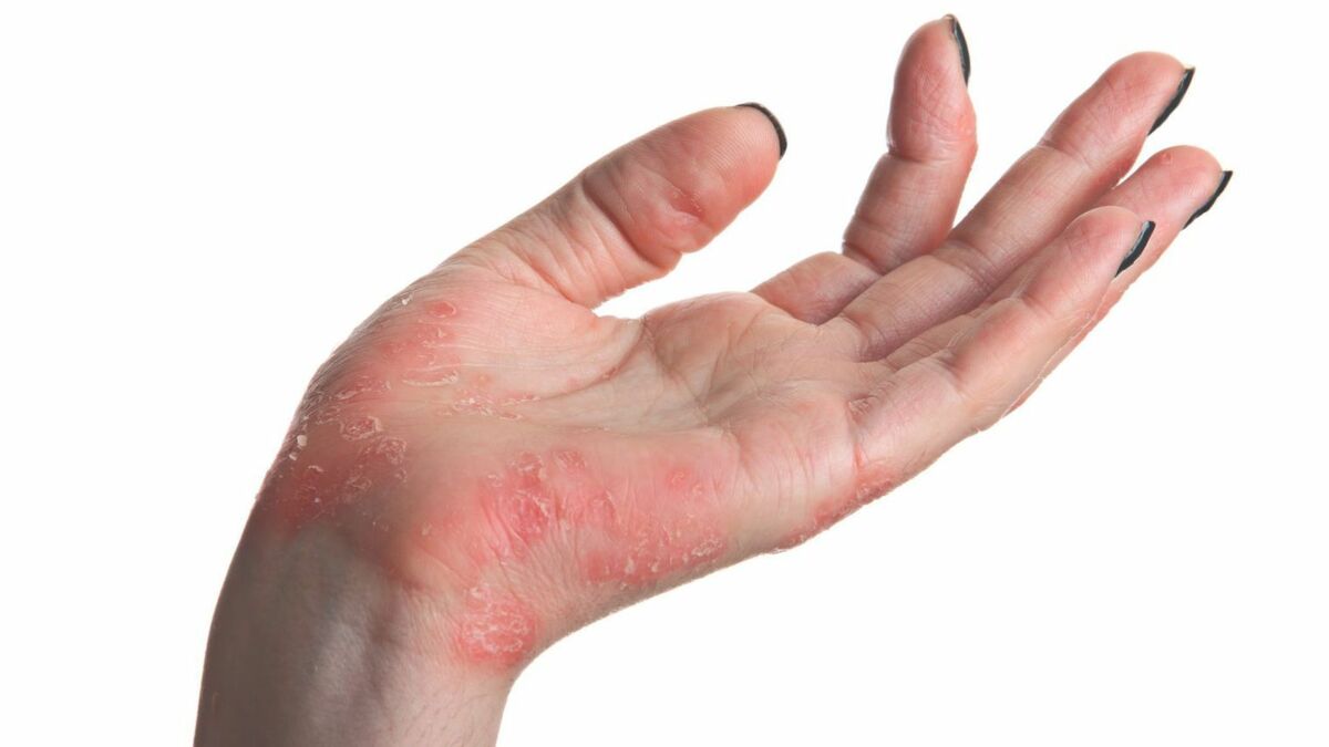 Le psoriasis : traitement, causes, symptômes, qu'est-ce que c'est?