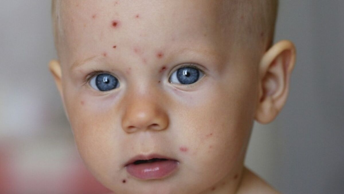 Varicelle : contagion, symptômes, traitement chez l'enfant, l ...