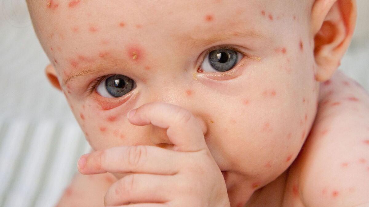 Varicelle Symptomes Contagion Traitement Tout Ce Qu Il Faut Savoir Varicelle Symptomes Contagion Traitement Tout Ce Qu Il Faut Savoir