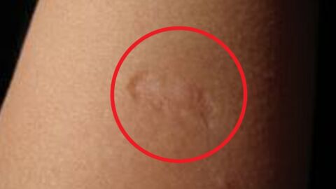 Voici la signification de la petite cicatrice présente sur le bras de certaines personnes !