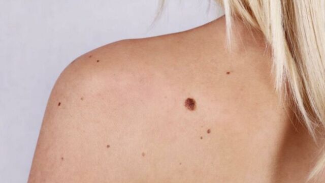 Cancer de la peau : ABCDE, la méthode simple et efficace pour repérer un  grain de beauté à risque