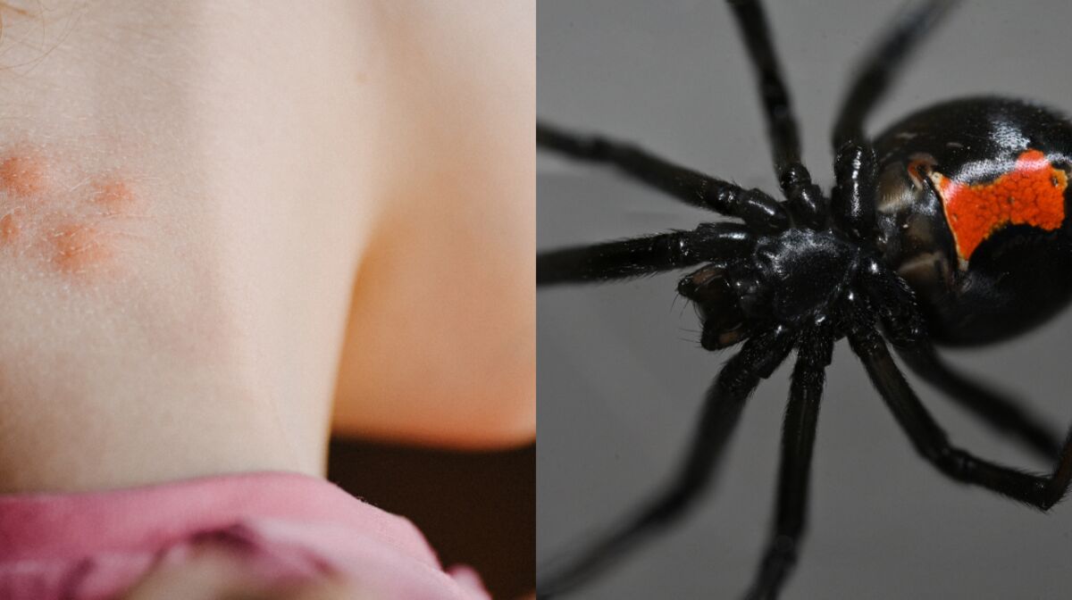 Je veux avertir la population: mordue par une araignée classée