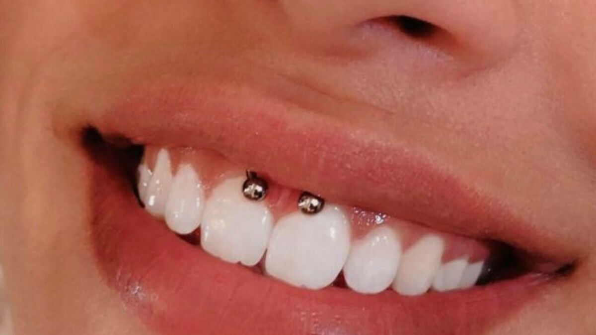 Piercing smiley : prix, douleur, danger tout sur ce piercing dans la  bouche