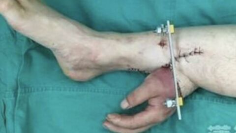 Des médecins greffent la main d'un patient sur sa cheville pour la maintenir en vie